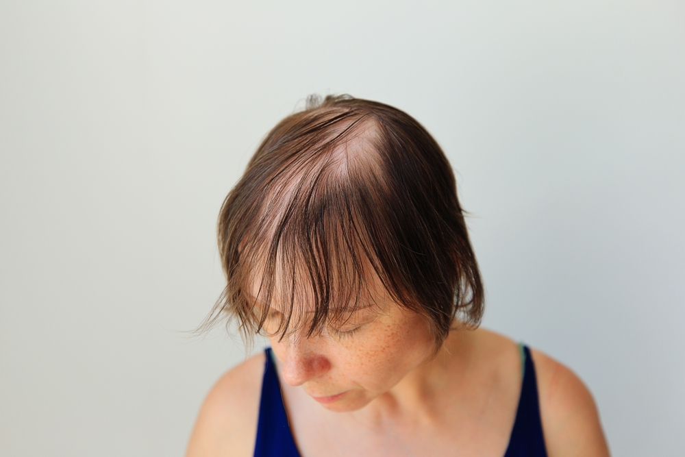 Hair Loss and thinning